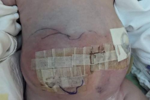 EMILKI-BRZUSZEK-PO-DRUGIEJ-OPERACJI